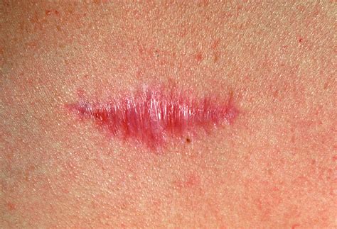 Keloid Scar Photograph by Gary Parker/science Photo Library - Pixels