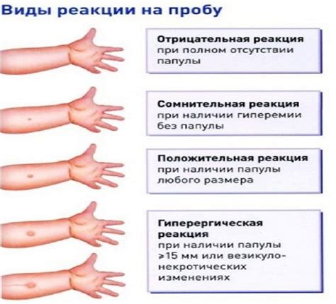 Реакція манту: норма розмірів у дорослих і оцінка результатів