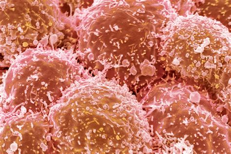 ‘Here’s How I Knew I Had Lung Cancer’: One Patient’s Story with