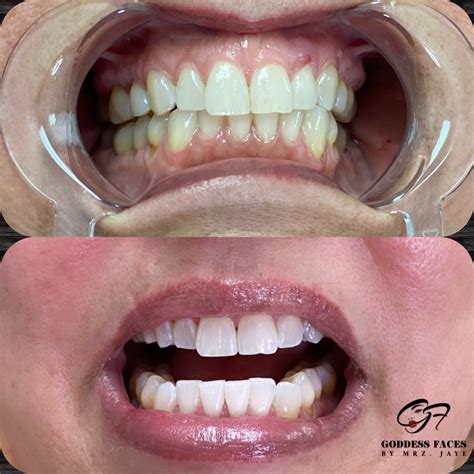 teethwhiteningtrainingflorida