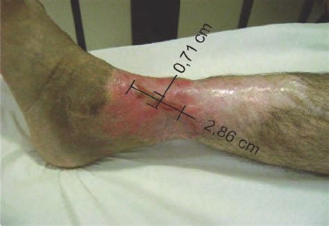 Reduction of lesion during treatment. | Download Scientific Diagram