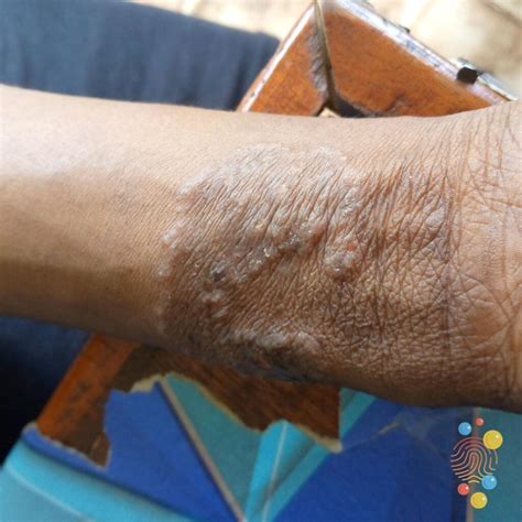 tinea corporis skin deep