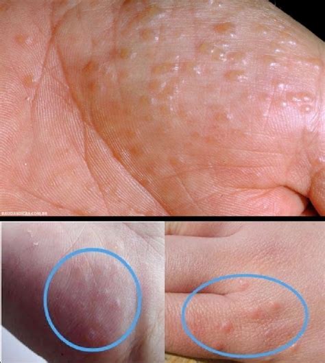 Bolhas Entre Os Dedos - Se surgirem bolhas em suas mãos e pés, fique atento; pode ser sintoma ...