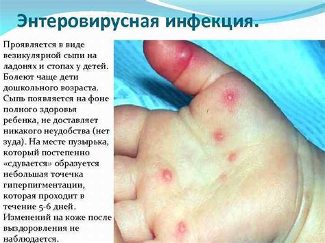 Синдром сыпей у детей v Сыпь
