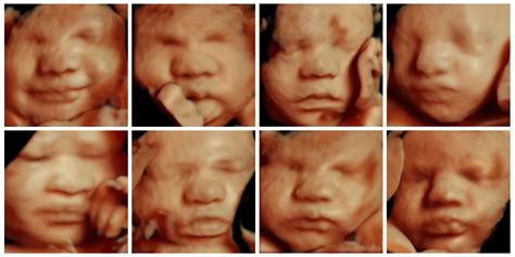 Before And After 3D Ultrasound Images, 54% OFF