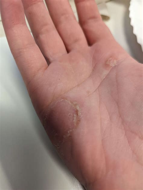 Ask a Dermatologist Online for Thought Its Ringworm But Does Not Respond T
