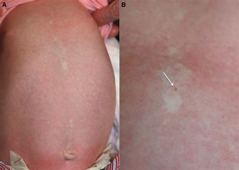 supraumbilical raphe