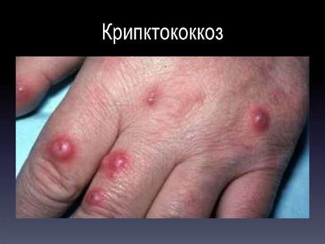 Оппортунистические инфекции - презентация онлайн
