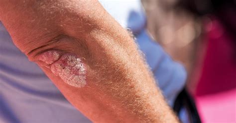 chronic plaque psoriasis  symptoms  treatment psoriasis