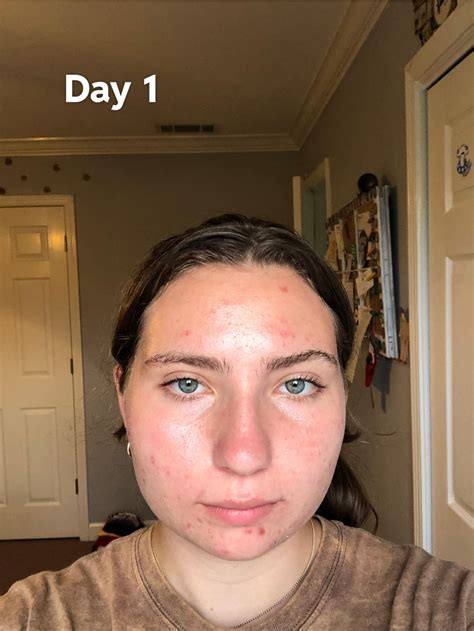 Accutane before and after : r/Accutane