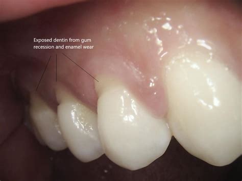 understanding exposed dentin  symptoms  treatment options