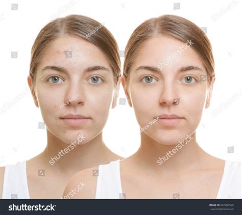 Young Woman Before After Acne Treatment Stock Photo 682205596 ...