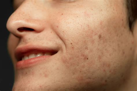 Post-Inflammatory Hyperpigmentation: A Guide | KINS Clinic