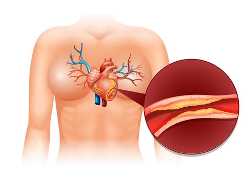 Coronary Angioplasty - Dr. Aditya Dhawale