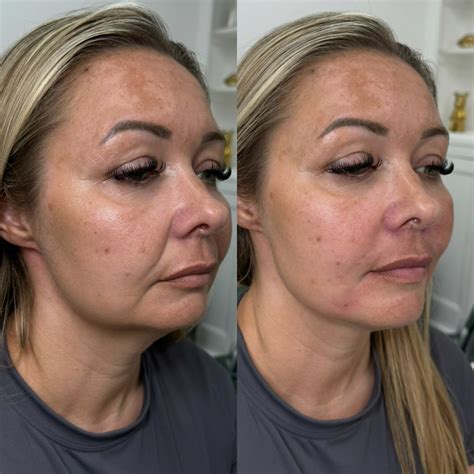 smile line filler before and after 8