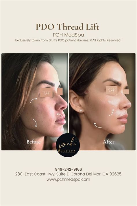 pdo thread lift  surgical facelift thread lift cosmetic