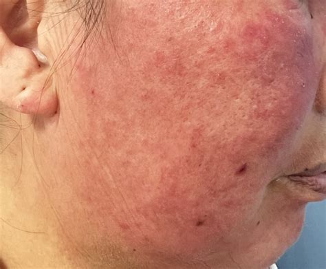A Natural Journey to Remission: Confronting Acute Cutaneous Lupus ...