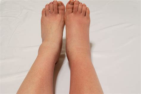 What to do for Prolonged Swelling in the Legs? | Doctors to Visit