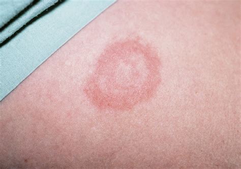 Tick Bitesgoodhousemag Symptoms Of Polycystic Ovaries, Symptoms Of ...