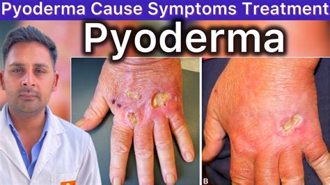 Pyoderma Cause Symptoms Diagnose Treatment Complication || Pyoderma ...