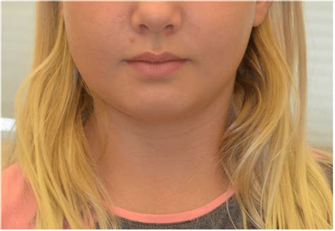 mild swelling    cheek  scientific diagram