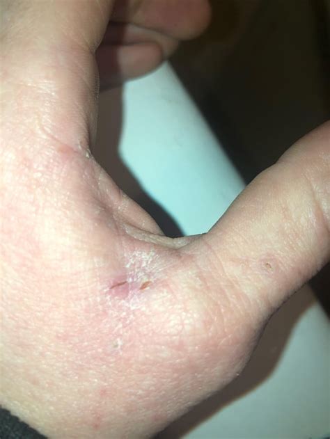 early signs of crusted scabies?! : r/scabies