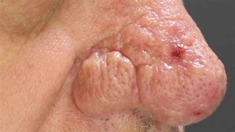 What Is Rhinophyma: Causes, Risk Factors & Symptoms