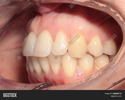 close side view teeth image photo  trial bigstock