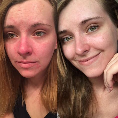 reduce skin redness face 3