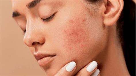 Ayurvedic Treatment of Skin Diseases - Permanent and Effective