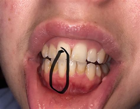 scared my tooth will fall out!!! I got my teeth checked 12 weeks ago, X