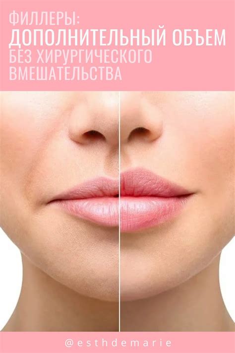 Филлеры: Дополнительный объем без хирургического вмешательства