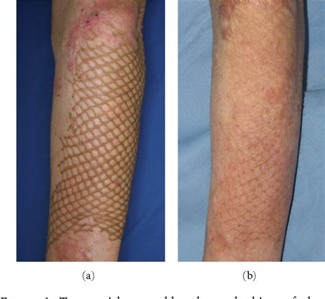 List 99+ Pictures Burn Skin Graft Before And After Pictures Stunning