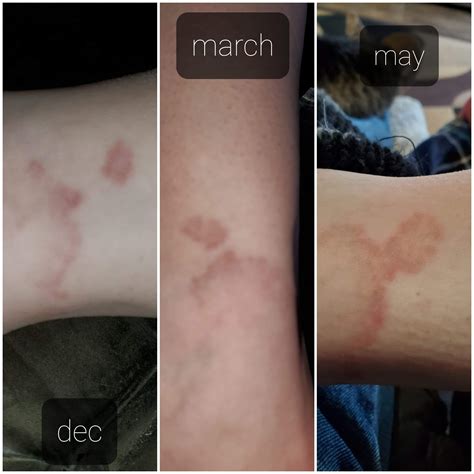 Odd bruise for 6 months : r/DiagnoseMe