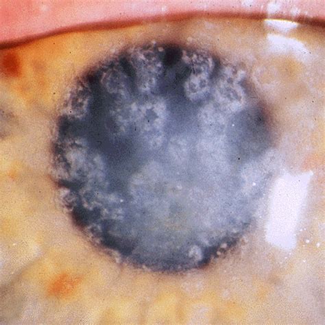 Granular corneal dystrophy - Wikipedia