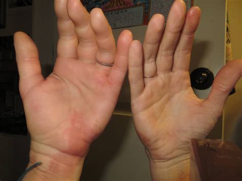 I accidentally injected insulin into my artery and my hand increased 2x