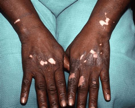 Melanin Nedir? - Cilt Hastalıkları ve Kozmetik