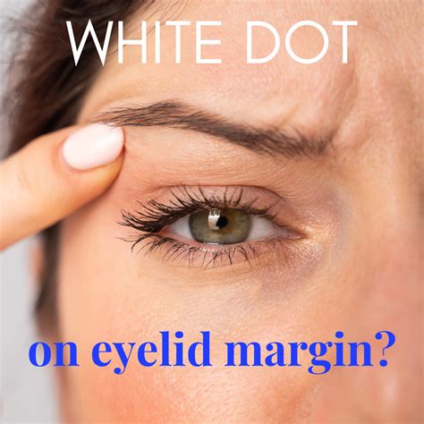 White Dot on Eyelid Margin: Common Causes and Expert Eye Care Tips fro ...