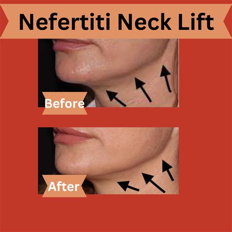 What is a Nefertiti Neck Lift? — Dr. Heather Friedman ND, LAc