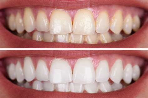 Emax Veneers - Beautiful Smiles in Birmingham