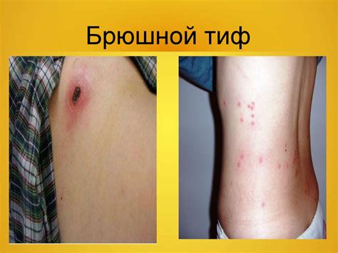 Брюшной тиф - презентация онлайн