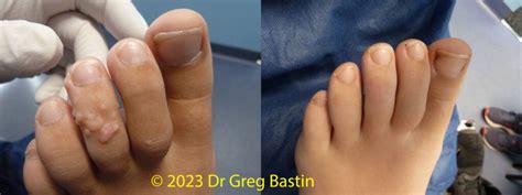 Wart Removal Melbourne: 100% Success at Brighton Podiatry