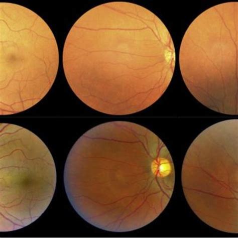 normal  abnormal retinal image  scientific diagram