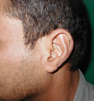 reconstruction  partial auricular defects  polypropylene mesh helix