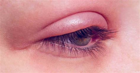 What Are the Signs and Symptoms of a Stye?