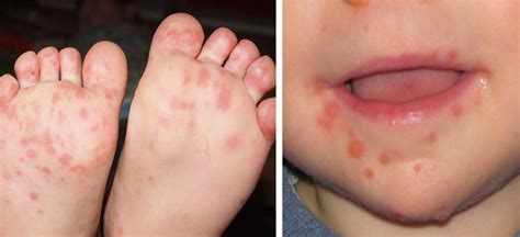foot hand  mouth virus  hand foot  mouth disease spreads