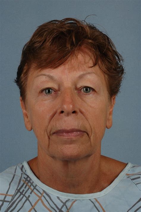 Little Rock Eyelid Surgery Patient Photo Case 14050