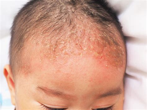 Seborrheic Dermatitis: Symptoms, Treatments, and More