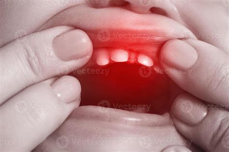 Baby suffering from painful teething symptoms 14394843 Stock Photo at ...