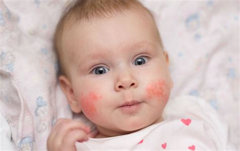 Atopijski dermatitis – veza između ishrane i kožnih bolesti - eKlinika
